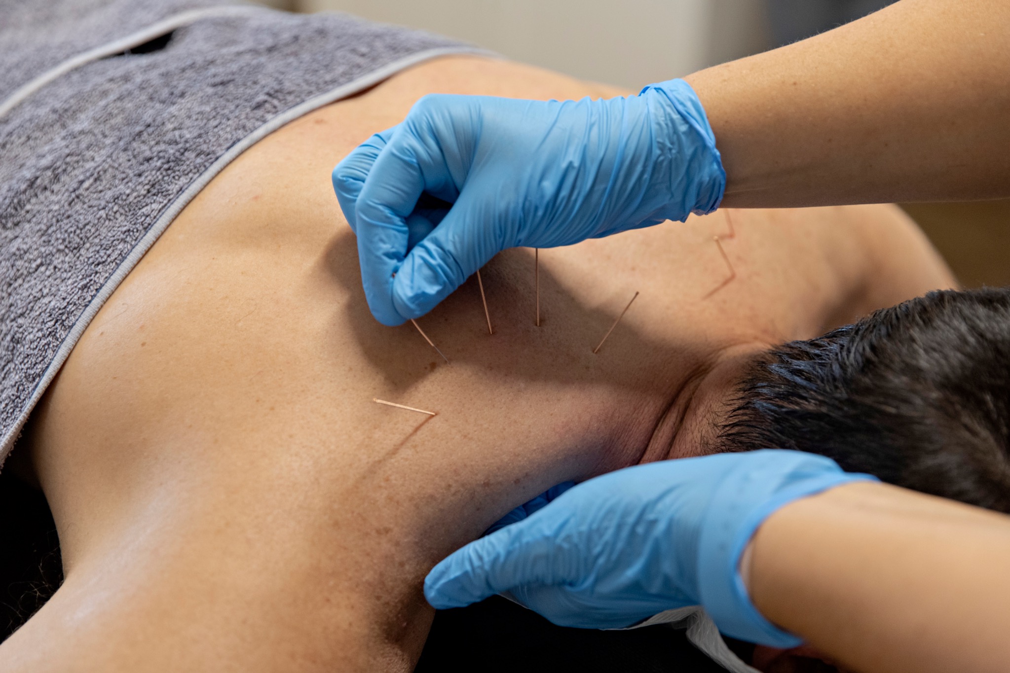 Dry needling treatment at Balance Physiotherapy and Pilates
